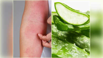 Aloe Vera For Sunburn: চাঁদিফাটা রোদে বেরতেই হাতে-মুখে চাকাচাকা ব়্যাশ? এভাবে অ্যালোভেরা লাগালে আরাম পাবেন