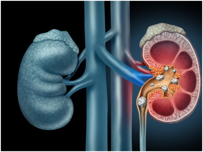 ಕಿಡ್ನಿ ಕಾಯಿಲೆಗಳು