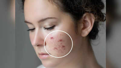 Blind Pimples: బ్లైండ్‌ పింపుల్స్‌ అంటే ఏమిటి..?