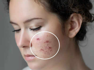 Blind Pimples: బ్లైండ్‌ పింపుల్స్‌ అంటే ఏమిటి..?