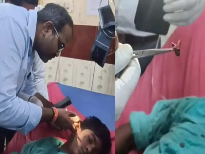 Doctors remove bee from student ear in Vellore