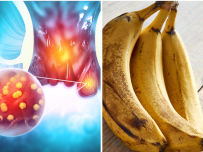 Banana For Piles: पुरानी से पुरानी बवासीर-कब्ज को जड़ से मिटा देगा केला, आयुर्वेद Dr ने बताया कब-कितने केले खाएं