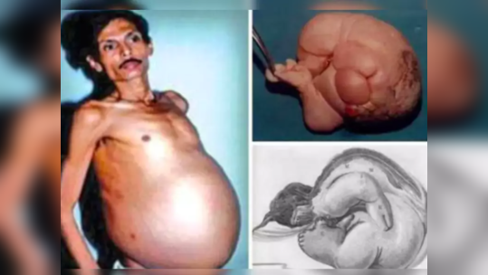 Pregnant Man : नागपुरातील पुरूष ३६ वर्षांपासून गरोदर, पोटात होती जुळी मुले, हे असं का होतं?