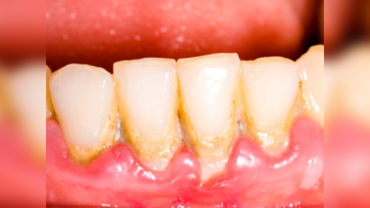 दातावर जमलेला पिवळा थर हटविण्यास मदत करेल घरगुती पेस्ट, आठड्यातून ३ वेळा वापर केल्याने मोत्यासारखे चमकतील