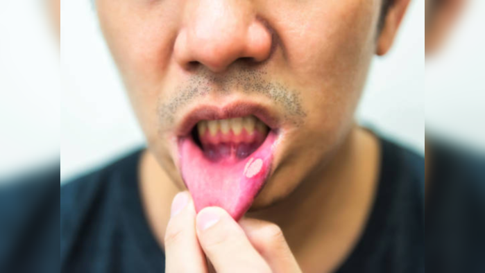 Mouth Ulcer: तोंडाची चव जातेय? असह्य वेदना अन् जळजळ होतेय मग तातडीने करा हे घरगुती उपाय
