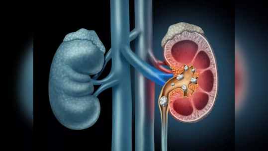 Kidney Stone Dissolving Food: किडनीत साचलेल्या मुतखड्यांचे झटक्यात पाणी करतात हे 6 पदार्थ, किडनी होते पूर्ण साफ