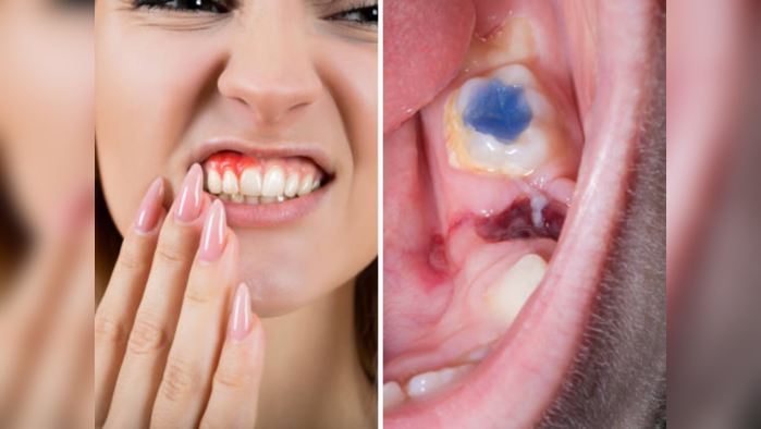 Bleeding Gums Remedies: ब्रश केल्यावर हिरड्यांमधून येत असेल रक्त ६ घरगुती उपाय ठरतील रामबाण