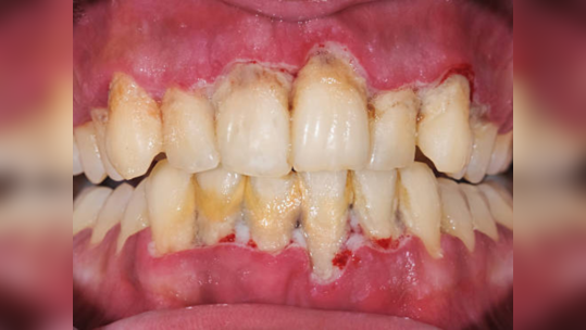 पिवळ्या दातांसाठी वापरा बेकिंग सोडा, हिऱ्यापेक्षाही चमकतील दात जाणून घ्या घरगुती उपाय