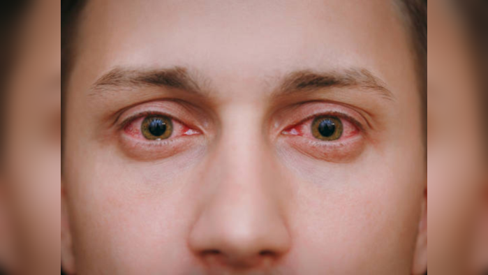 Eye Flu वर ७ आयुर्वेदिक उपाय ठरतील गुणकारी, डोळ्याची सूज-खुपणं यावर मिळेल आराम
