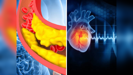 नसा सडवतील High Cholesterol, ५ लक्षणांकडे करू नका दुर्लक्ष येईल हार्ट अटॅक