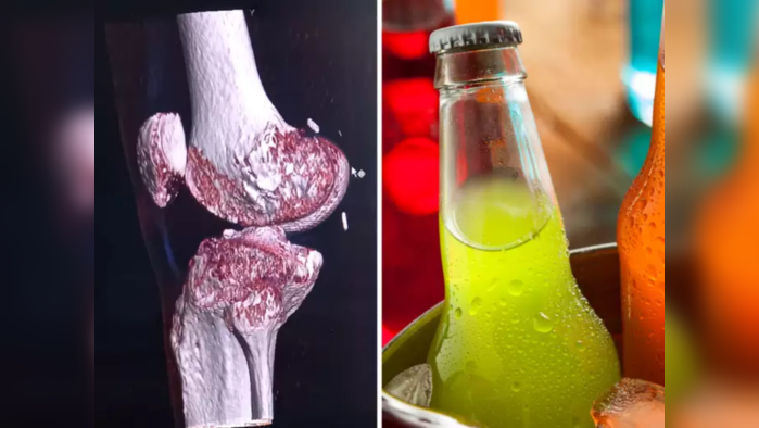 Harmful Drinks For Bones : हाडे मेणासारखी वितळवतात हे 2 पदार्थ, व्हिटॅमिन D व B12 खेचून घेतात, यापुढे विषही फेल