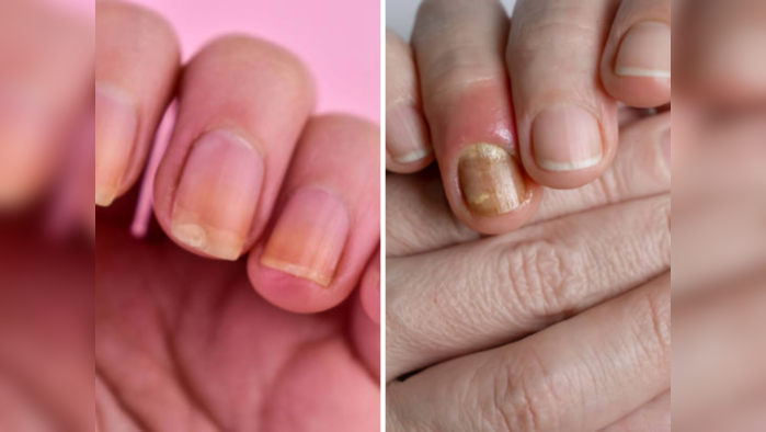 Tips for Beautiful Nails : पिवळ्याधम्मक नखांची लाज वाटते?, तुमच्या नखांच्या रंगावरून कळतं तुमचं आरोग्य!