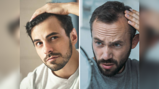 Male Baldness: या विचित्र कारणांनी पुरुषांना पडते टक्कल, वेळेत करा हे काम, डोक्यावरचा एकही केस गळणार नाही