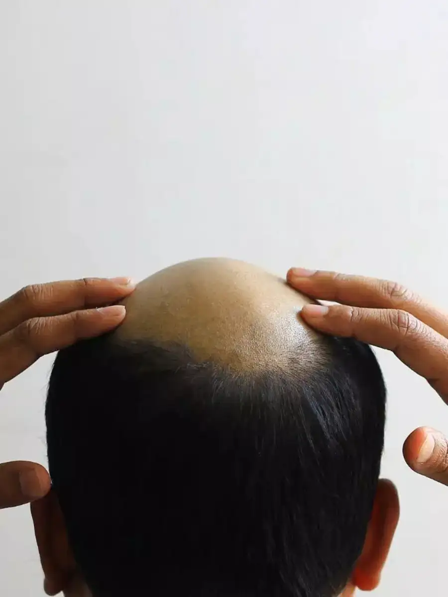 Baldness Home Remedies| കഷണ്ടി മാറ്റി മുടി വളരാൻ വീട്ടിൽ തന്നെ ...