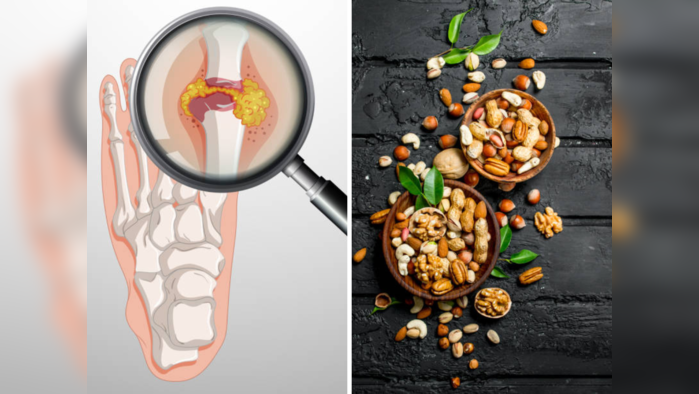 शरीरात युरिक अ‍ॅसिडची पातळी उच्च झाली आहे, ६ ड्रायफ्रूट्स आहेत रामबाण इलाज