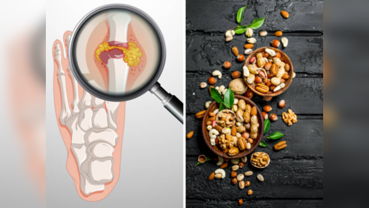 शरीरात युरिक अ‍ॅसिडची पातळी उच्च झाली आहे, ६ ड्रायफ्रूट्स आहेत रामबाण इलाज