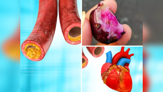 मेणासारखं घाण Cholesterol कायमचं छुमंतर करतात ही 6 फळं, बंद पडलेल्या रक्ताच्या नसा उघडून 100 स्पीडने धावतं रक्त