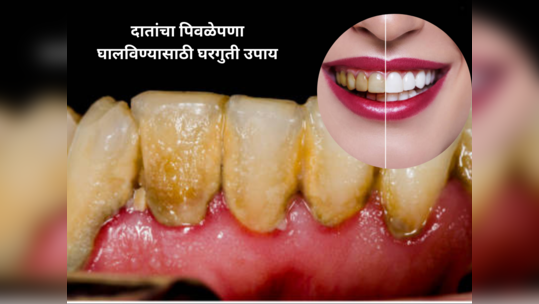 दातांवर जमलाय पिवळा थर हसण्याची वाटतेय लाज, ५ पदार्थ त्वरीत घालवतील दातांचा पिवळेपणा