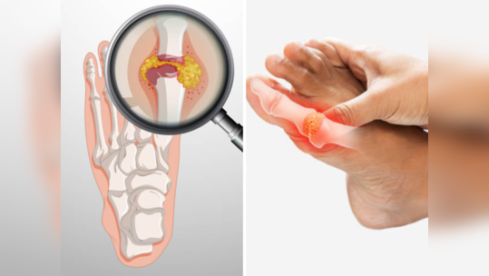 Uric Acid झर्रकन कमी करतात ही हिरवी पानं, गाऊटवरही ठरेल रामबाण उपाय