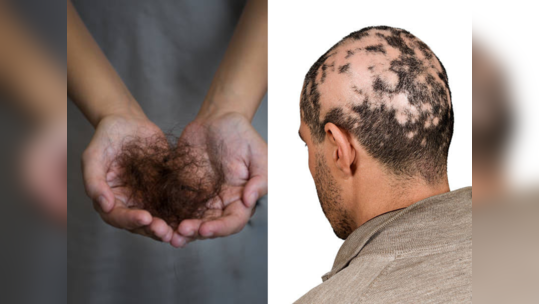 केस विंचरल्यावर गुच्छा येतोय हातात असू शकतो गंभीर आजार, टक्कल पडण्याचा कोणाला आहे धोका