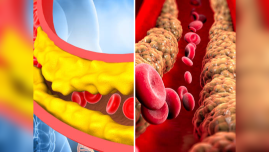 सकाळच्या या ५ सवयी काढून टाकेल नसांमधील साचलेले घाणेरडे कोलेस्ट्रॉल, High Cholesterol असणाऱ्यांनी घ्या काळजी