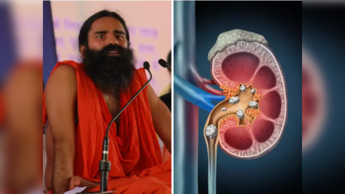 Kidney Stones : मुतखडे विरघळून लघवीतून पडतील झटक्यात बाहेर, करा रामदेव बाबांचे हे उपाय, औषध व ऑपरेशनची गरज नाही