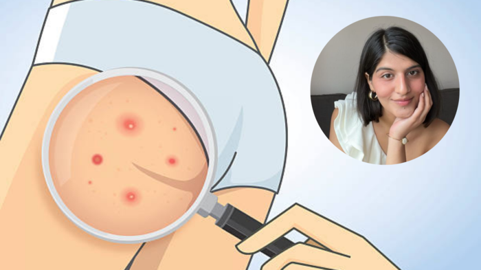 बसताना नकोशा वेदना,Butt Acne च्या त्रासावर डॉक्टरांनी सांगितला उपाय,ही गोष्ट वापरल्यास नितंबावरील पिंपल्स होतील गायब