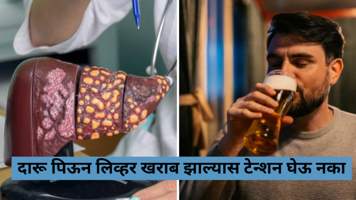 Liver failure: दारू पिऊन लिव्हर डॅमेज झाल्यास टेन्शन घेऊ नका, डॉ सरीनने सांगितले घरगुती उपाय