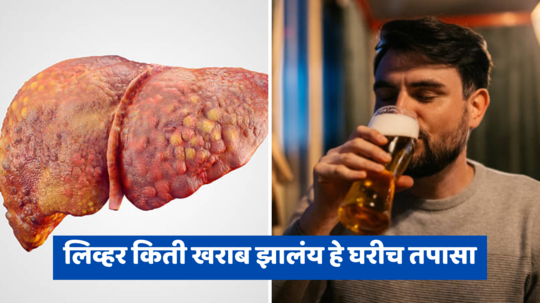 Liver Failure : दारूचा प्रत्येक थेंब करतो नुकसान, लिव्हर किती खराब झालंय हे घरीच तपासा