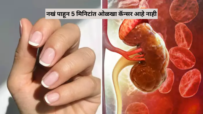 Cancer Symptoms: तुम्हाला त्वचा, डोळे, किडनी, रक्ताचा कॅन्सर तर झाला नाही ना? फक्त नखं बघून 5 मिनिटांत असं ओळखा