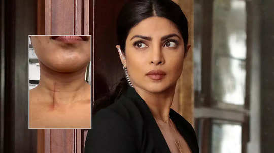 सिनेमाच्या सेटवर अपघात, थोडक्यात बचावली Priyanka Chopra ,  तो फोटो पाहून चाहते चिंतेत