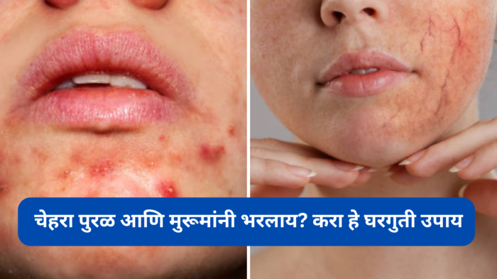 Acne Treatment:चेहरा पुरळ आणि मुरूमांनी भरलाय? करा हे घरगुती उपाय