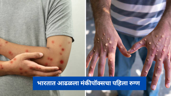 Monkeypox virus: भारतात आढळला मंकीपॉक्सचा पहिला रुग्ण, शरीराच्या या भागांवर होतो परिणाम