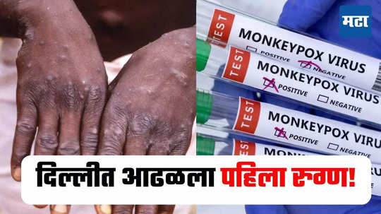 Monkey pox : भारतात मंकी पॉक्सचा शिरकाव! दिल्लीत आढळला पहिला रुग्ण