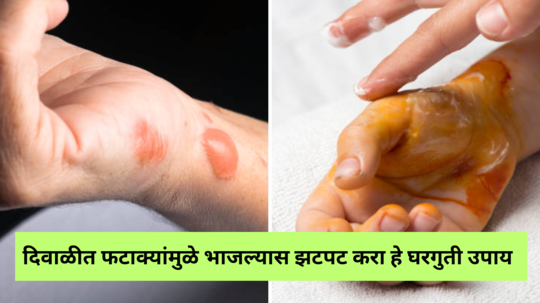 FireCracker Burns Injuries: दिवाळीत फटाक्यांमुळे भाजल्यास झटपट करा हे घरगुती उपाय