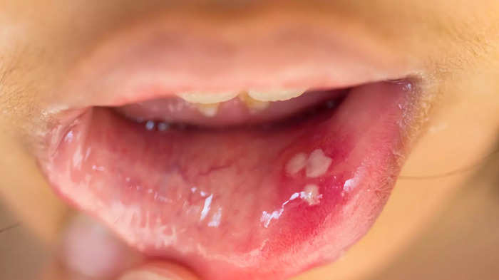 Ulcer