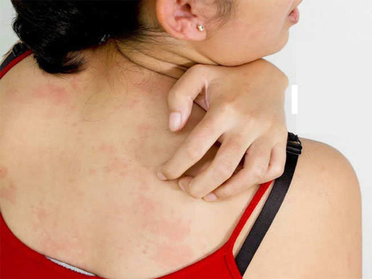 Psoriasis Treatment स र यस स क द र कर ग य 7 न चरल तर क ज न व स त र स 7 Natural Ways To Treat Psoriasis Know Everything About This Skin Related Disease Navbharat Times