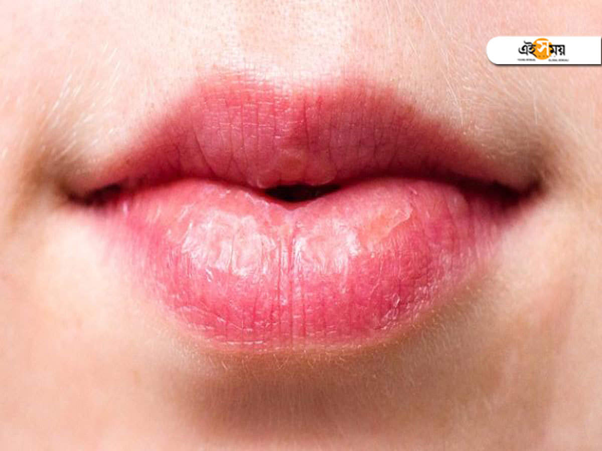 Lips Care In Summer গরম ও ঠ ট ফ টছ অন য ক ছ নয ত স বধ ন Chapped Lips In Summer Could Be A Sign Of Something Else Eisamay