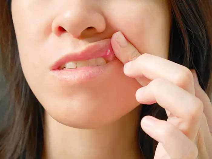 Home remedies for mouth ulcer: इन घरेलू तरीकों से ठीक हो जाएगा Mouth Ulcer,  जानें कारण भी - best home remedies to treat mouth ulcer as well as its  causes | Navbharat Times