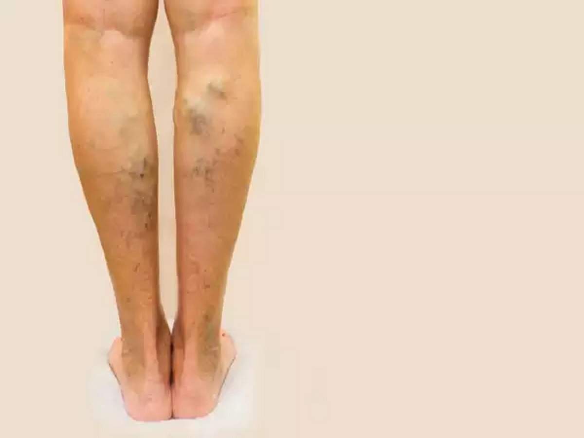Cum să alegeți și să purtați genunchi ortopedici pentru varice - Structura August