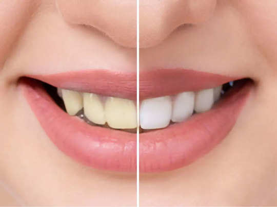 baking soda se teeth whitening in hindi