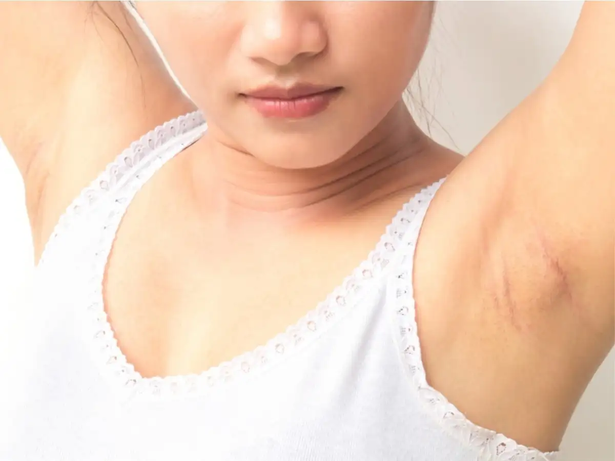 dark underarms treatment: Home Remedies: 15 मिनट में अंडरआर्म्स का कालापन  ऐसे करें दूर, गारंटी के साथ मिलेगा रिजल्‍ट - how to get rid of dark  underarms overnight tips | Navbharat Times