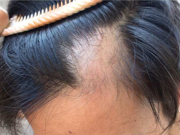 hair loss front of head female: Hair Loss: क्‍या माथे से ...