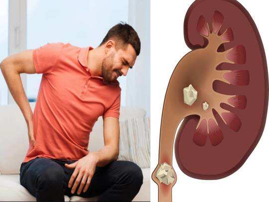symptoms of kidney stone, Symptoms Of Kidney Stone : बैक पेन के बाद जांच  में निकले 3 किडनी स्टोन, कहीं आपको भी तो नहीं यह लक्षण - are you feeling  pain in