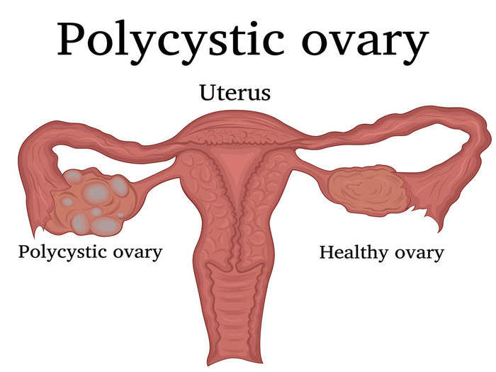 PCOD: PCOD की समस्या के बारे में वो सबकुछ, जो आपको पता होना चाहिए -  polycystic ovary disease reasons and precautions in hindi | Navbharat Times