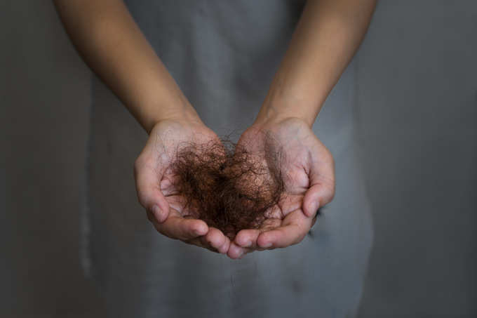 A woman suffering from hair loss.