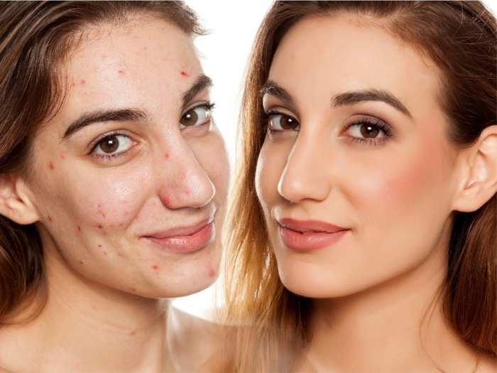 How To Hide Acne Scars With Makeup म कअप स ऐस छ प ए म ह स क द ग धब ब Navbharat Times