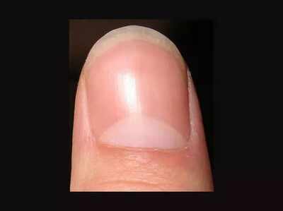white marks on nails indicates: నలుపు రంగు మచ్చలున్నట్లయితే.. - చేతి గోళ్లపై ఈ మచ్చలుంటే అదృష్టం మీ వెంటే..! - Samayam Telugu Photogallery white marks on nails indicates: నలుపు రంగు మచ్చలున్నట్లయితే.. - చేతి గోళ్లపై ఈ మచ్చలుంటే అదృష్టం మీ వెంటే..! - Samayam Telugu Photogallery