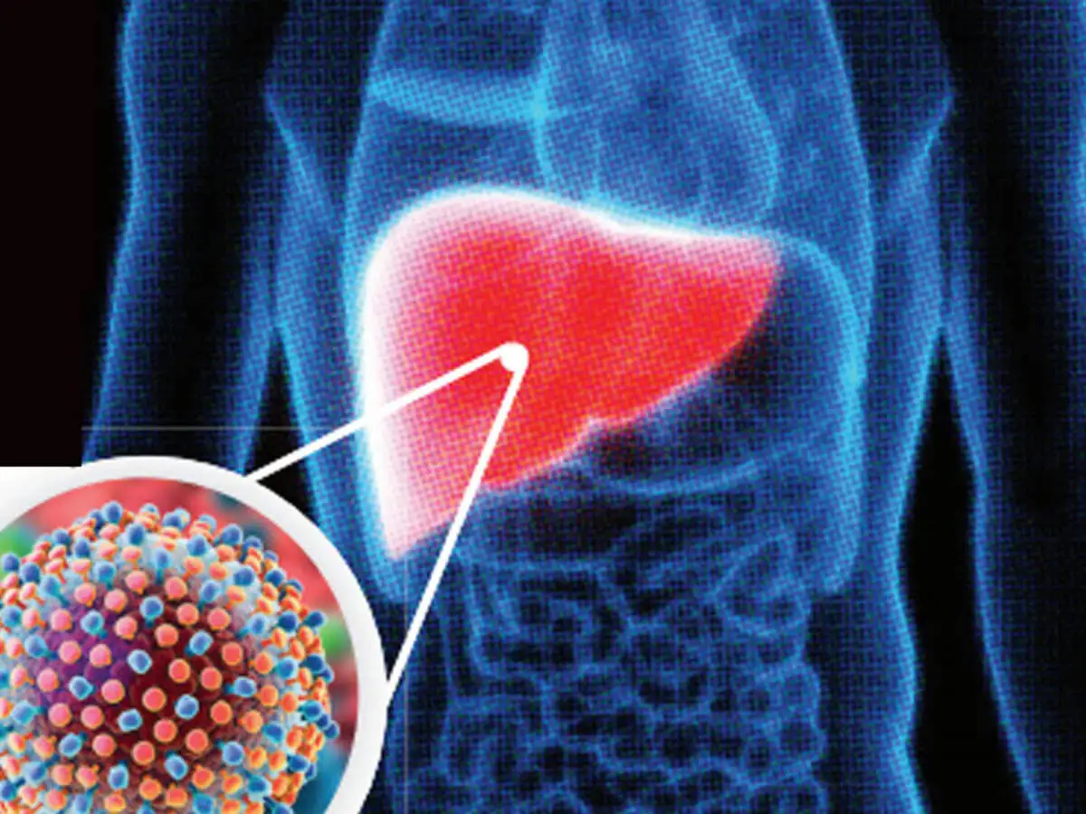 Symptoms Of Chronic Hepatitis C Hepatitis C Virus À¤ªà¤¹à¤ À¤¨ À¤à¤¯ À¤à¤¸ À¤¬ À¤® À¤° À¤ À¤µ À¤¯à¤°à¤¸ À¤ À¤¨ À¤ À¤° À¤¨ À¤ À¤¹ À¤ª À¤ À¤à¤ À¤¸ À¤¸ À¤ À¤²à¤ À¤·à¤£ À¤à¤¸à¤¸ À¤¬à¤à¤¨ À¤ À¤à¤ª À¤¯ Hepatitis C Virus Discovery And Medicine