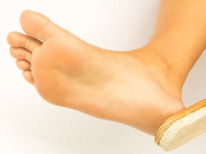 foot care tips cracked heels
